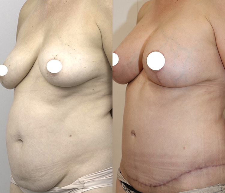 Tummy tuck before and after (abdominoplasty) 04, angle view