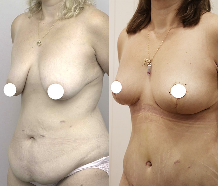 tummy tuck before and after - image 005 - front view