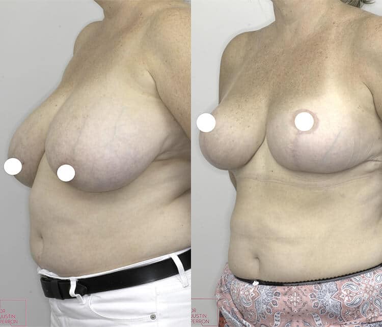 Breast reduction before and after 02, 45 degree view, Dr Perron Brisbane