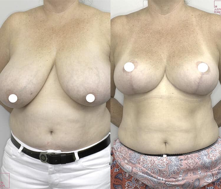 Breast reduction patient before and after surgery 03, front view